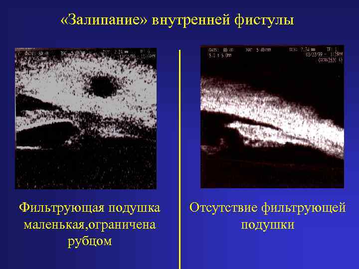  «Залипание» внутренней фистулы Фильтрующая подушка маленькая, ограничена рубцом Отсутствие фильтрующей подушки 