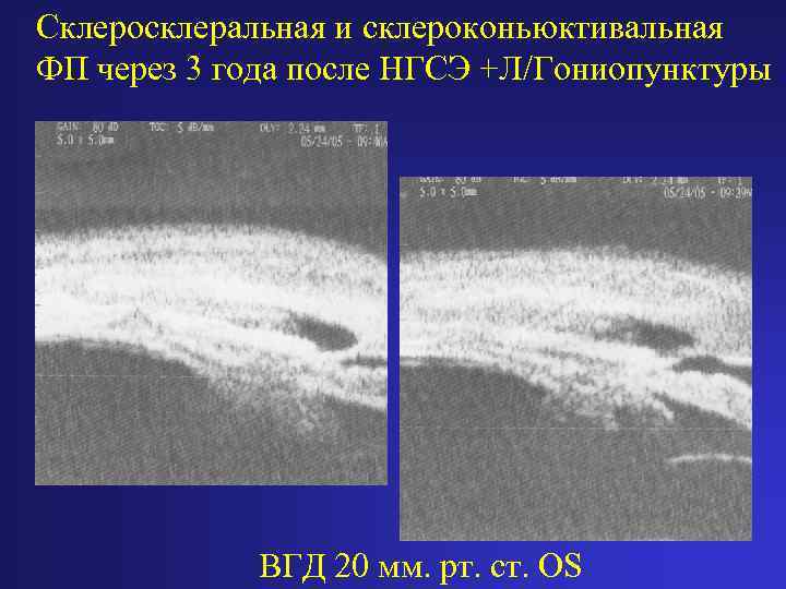 Склеросклеральная и склероконьюктивальная ФП через 3 года после НГСЭ +Л/Гониопунктуры ВГД 20 мм. рт.