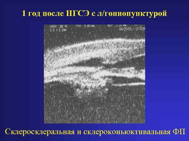 1 год после НГСЭ с л/гониопунктурой Склеросклеральная и склероконьюктивальная ФП 