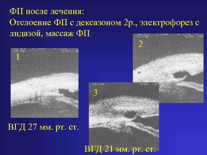 ФП после лечения: Отслоение ФП с дексазоном 2 р. , электрофорез с лидазой, массаж