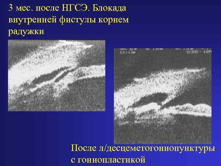 3 мес. после НГСЭ. Блокада внутренней фистулы корнем радужки После л/десцеметогониопунктуры с гониопластикой 