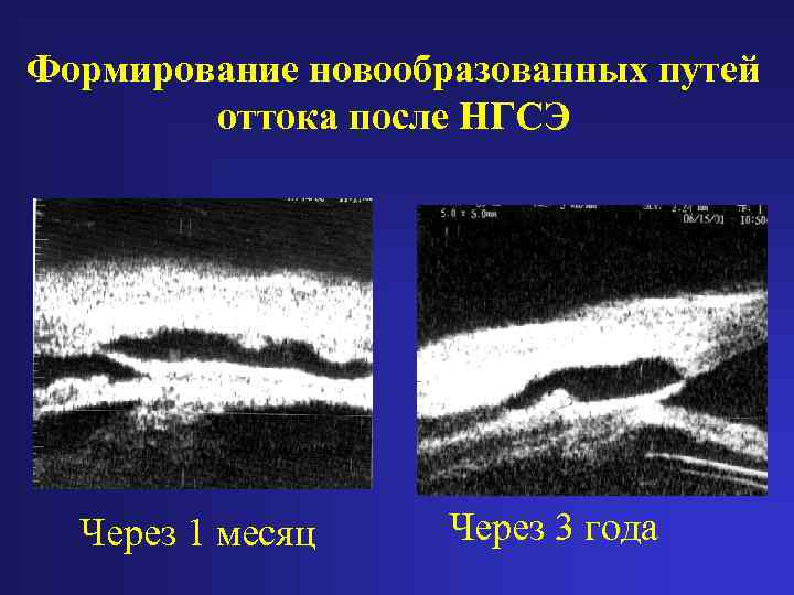 Формирование новообразованных путей оттока после НГСЭ Через 1 месяц Через 3 года 
