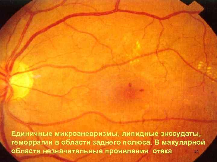 Единичные микроаневризмы, липидные экссудаты, геморрагии в области заднего полюса. В макулярной 24 области незначительные