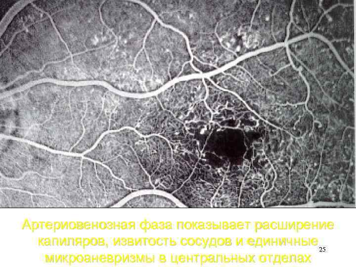Артериовенозная фаза показывает расширение капиляров, извитость сосудов и единичные 25 микроаневризмы в центральных отделах