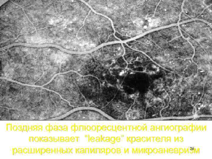 Поздняя фаза флюоресцентной ангиографии показывает “leakage” красителя из 26 расширенных капиляров и микроаневризм 