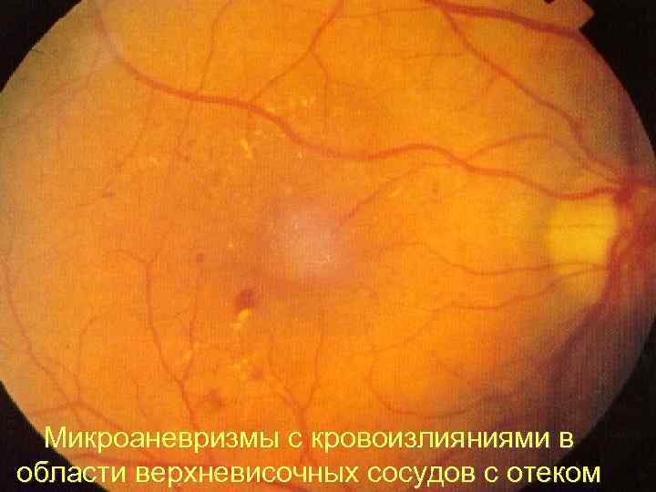 Микроаневризмы с кровоизлияниями в 28 области верхневисочных сосудов с отеком 