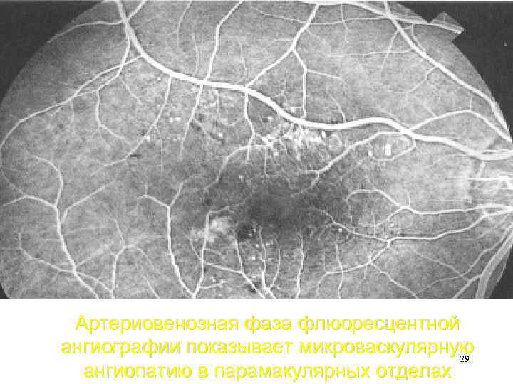 Артериовенозная фаза флюоресцентной ангиографии показывает микроваскулярную 29 ангиопатию в парамакулярных отделах 