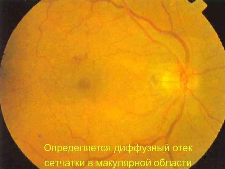 Определяется диффузный отек сетчатки в макулярной области 32 