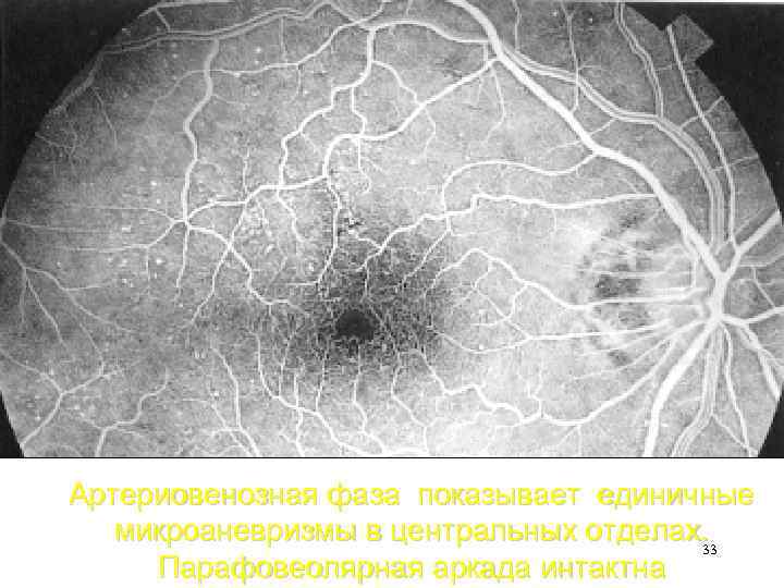 Артериовенозная фаза показывает единичные микроаневризмы в центральных отделах. 33 Парафовеолярная аркада интактна 