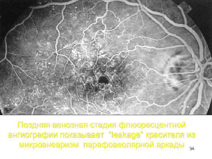 Поздняя венозная стадия флюоресцентной ангиографии показывает “leakage” красителя из микроаневризм парафовеолярной аркады 34 