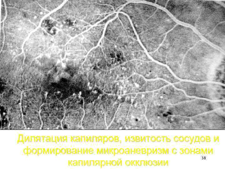 Дилятация капиляров, извитость сосудов и формирование микроаневризм с зонами 38 капилярной окклюзии 