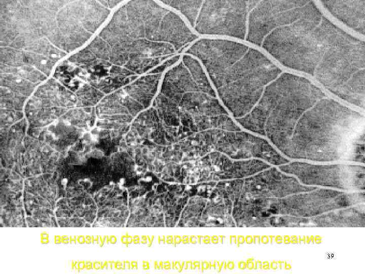 В венозную фазу нарастает пропотевание красителя в макулярную область 39 