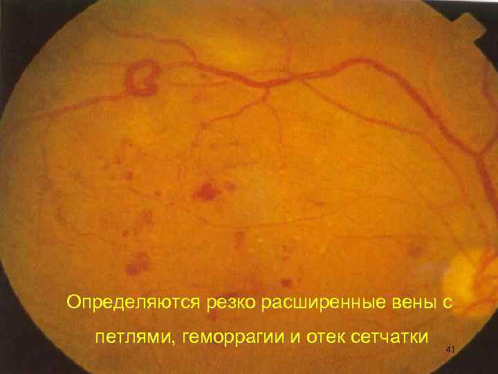 Определяются резко расширенные вены с петлями, геморрагии и отек сетчатки 41 