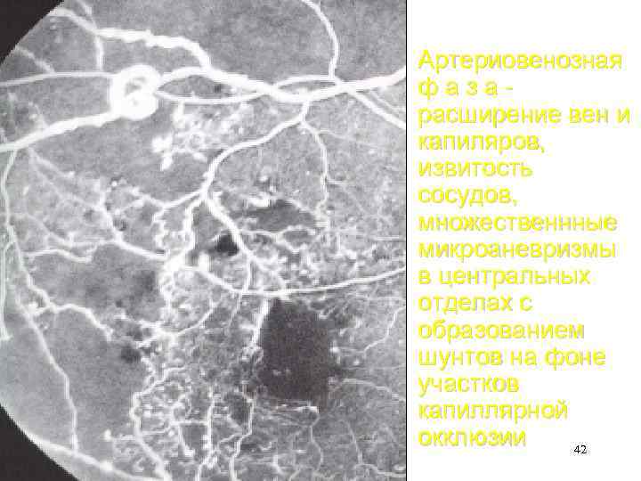 Артериовенозная фазарасширение вен и капиляров, извитость сосудов, множественнные микроаневризмы в центральных отделах с образованием