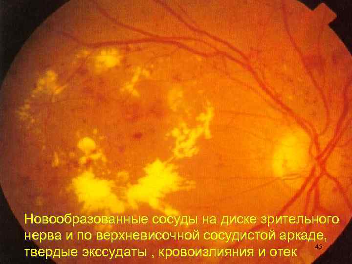 Новообразованные сосуды на диске зрительного нерва и по верхневисочной сосудистой аркаде, 45 твердые экссудаты