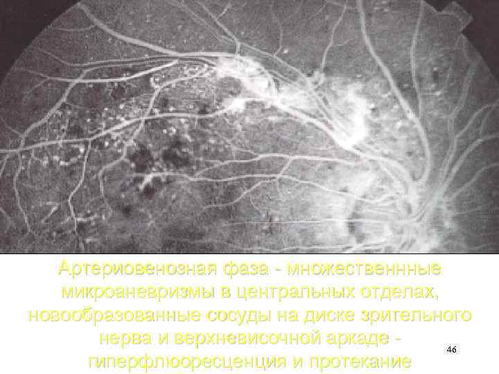 Артериовенозная фаза - множественнные микроаневризмы в центральных отделах, новообразованные сосуды на диске зрительного нерва