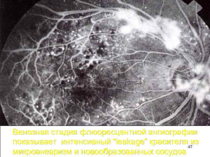 Венозная стадия флюоресцентной ангиографии показывает интенсивный “leakage” красителя 47 из микроаневризм и новообразованных сосудов