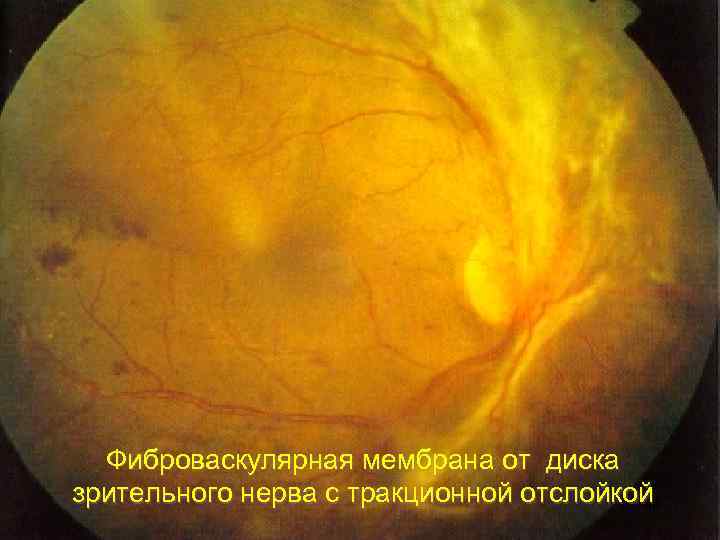 Фиброваскулярная мембрана от диска зрительного нерва с тракционной отслойкой 48 