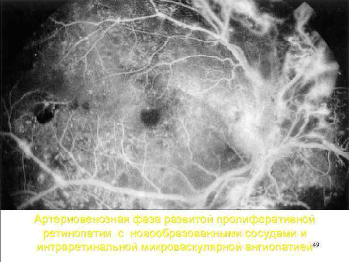 Артериовенозная фаза развитой пролиферативной ретинопатии с новообразованными сосудами и интраретинальной микроваскулярной ангиопатией 49 