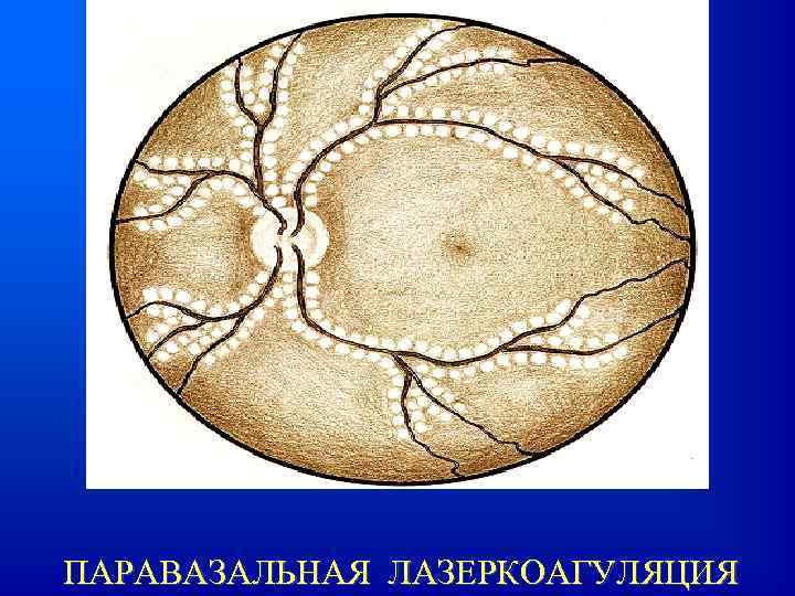 ПАРАВАЗАЛЬНАЯ ЛАЗЕРКОАГУЛЯЦИЯ 