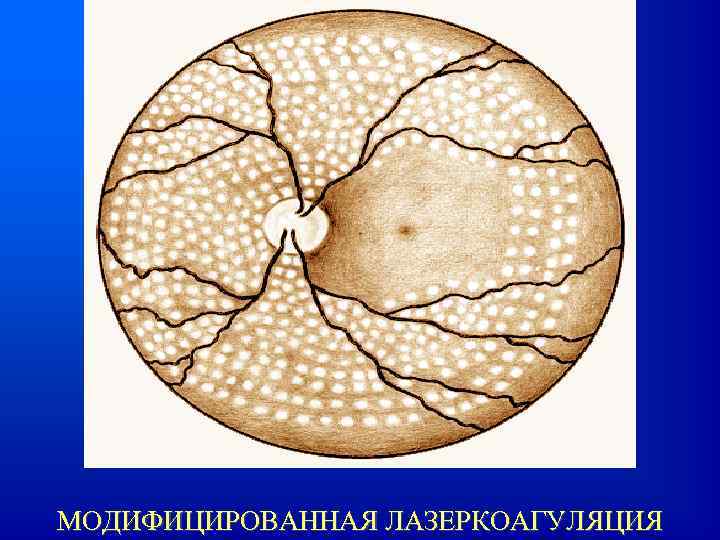 МОДИФИЦИРОВАННАЯ ЛАЗЕРКОАГУЛЯЦИЯ 