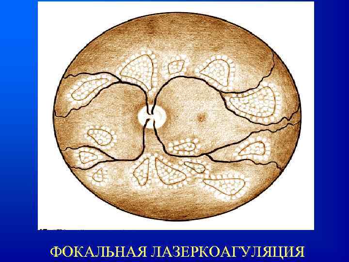 ФОКАЛЬНАЯ ЛАЗЕРКОАГУЛЯЦИЯ 