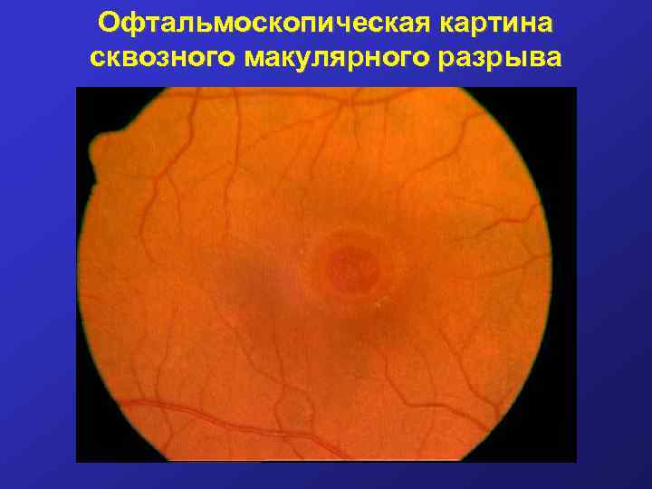 Офтальмоскопическая картина сквозного макулярного разрыва 