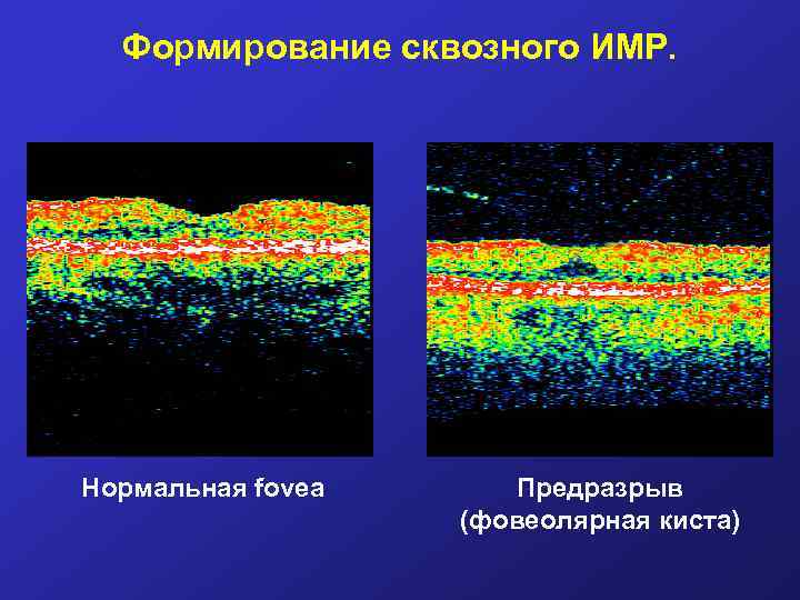Формирование сквозного ИМР. Нормальная fovea Предразрыв (фовеолярная киста) 