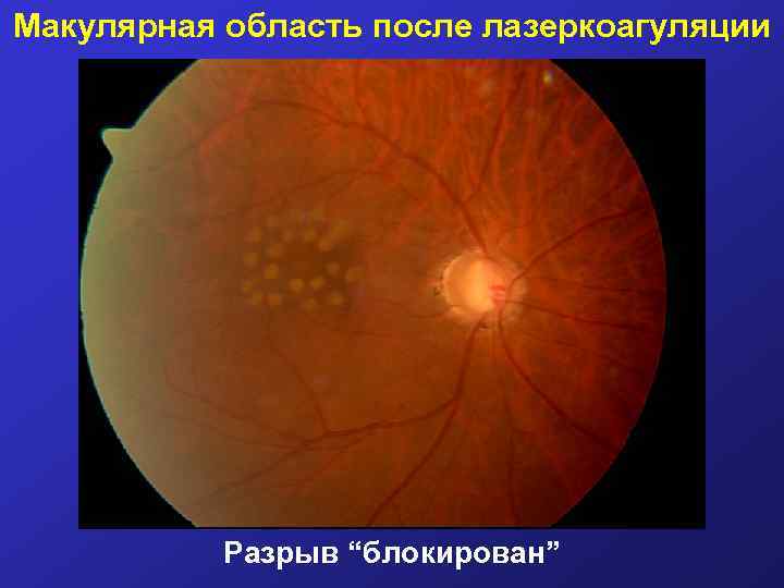 Макулярная область после лазеркоагуляции Разрыв “блокирован” 