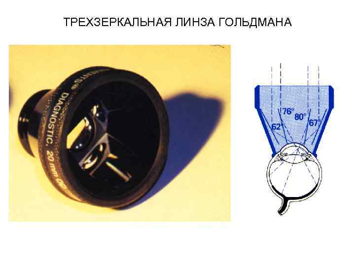 ТРЕХЗЕРКАЛЬНАЯ ЛИНЗА ГОЛЬДМАНА 