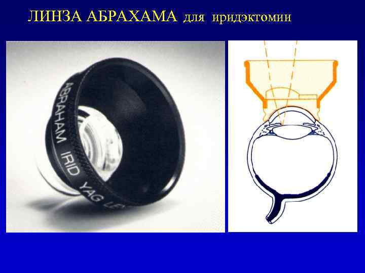 ЛИНЗА АБРАХАМА для иридэктомии 
