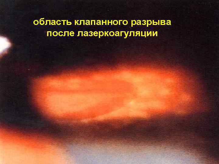 область клапанного разрыва после лазеркоагуляции 