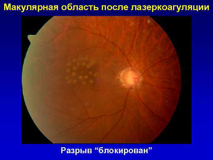 Макулярная область после лазеркоагуляции Разрыв “блокирован” 