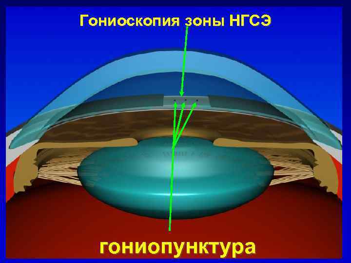 Гониоскопия зоны НГСЭ гониопунктура 