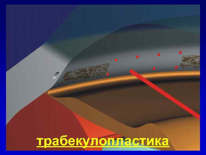 трабекулопластика 