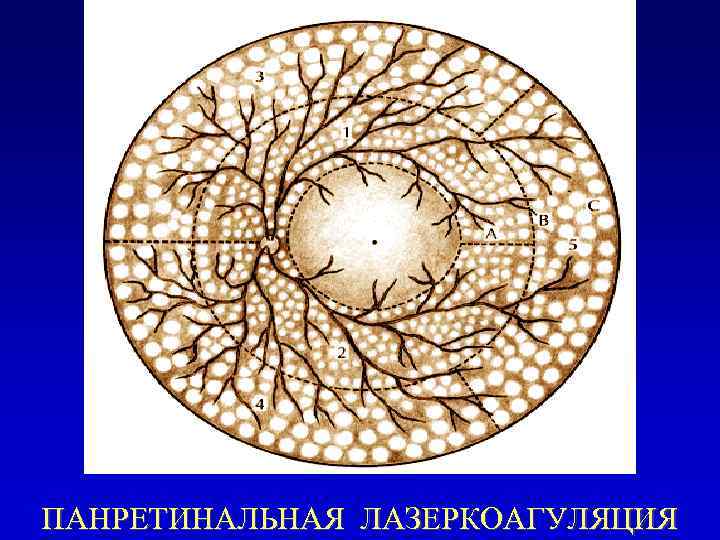 ПАНРЕТИНАЛЬНАЯ ЛАЗЕРКОАГУЛЯЦИЯ 