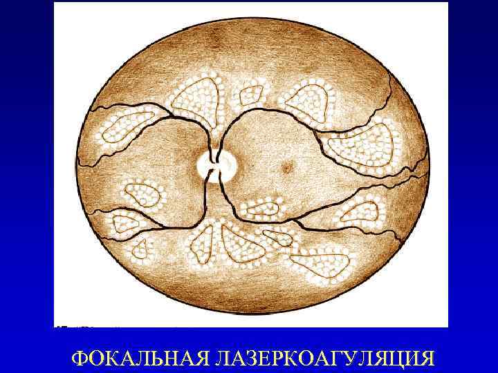 ФОКАЛЬНАЯ ЛАЗЕРКОАГУЛЯЦИЯ 