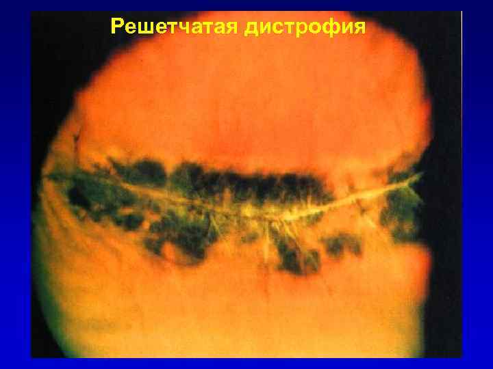 Решетчатая дистрофия 