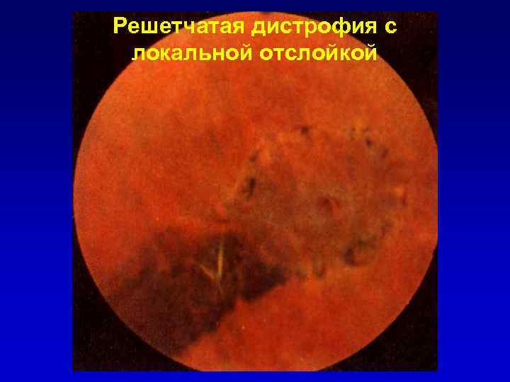 Решетчатая дистрофия с локальной отслойкой 