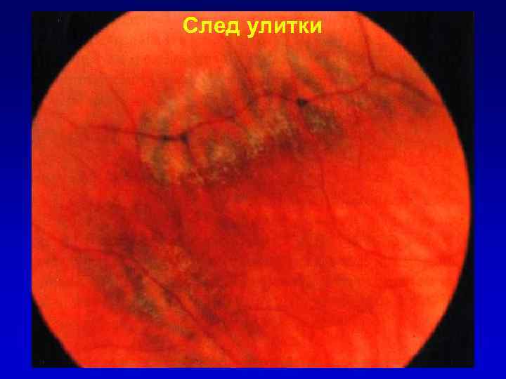 След улитки 