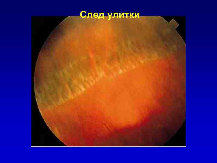 След улитки 