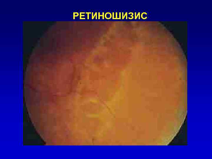 РЕТИНОШИЗИС 