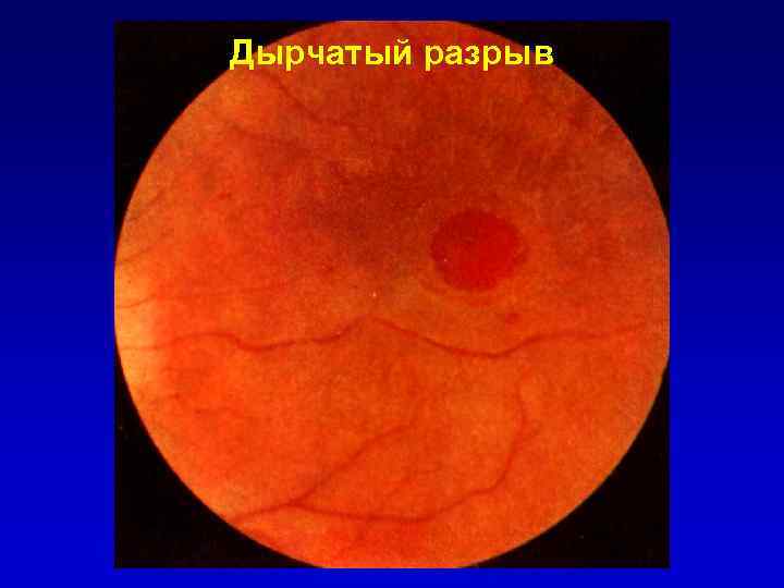 Дырчатый разрыв 