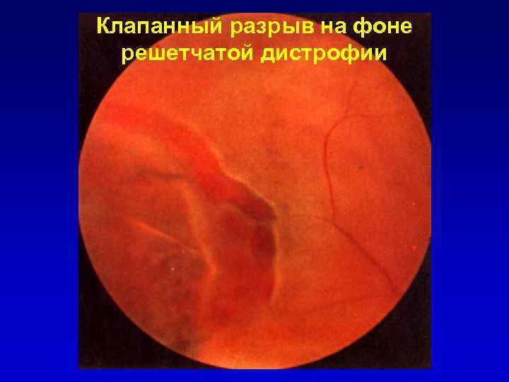 Клапанный разрыв на фоне решетчатой дистрофии 