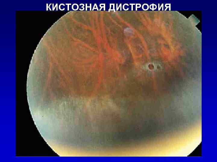 КИСТОЗНАЯ ДИСТРОФИЯ 