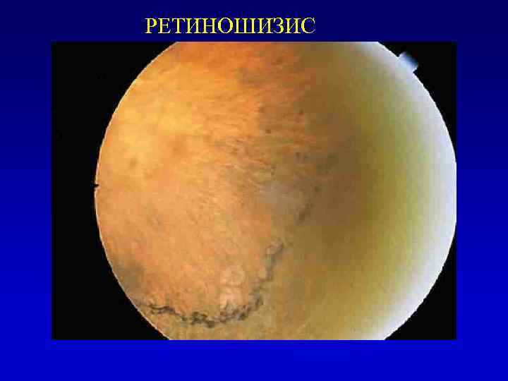 РЕТИНОШИЗИС 