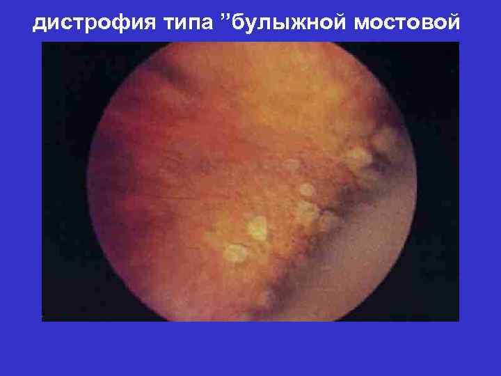 дистрофия типа ”булыжной мостовой” 