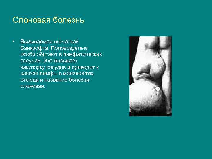Слоновая болезнь • Вызываемая нитчаткой Банкрофта. Половозрелые особи обитают в лимфатических сосудах. Это вызывает