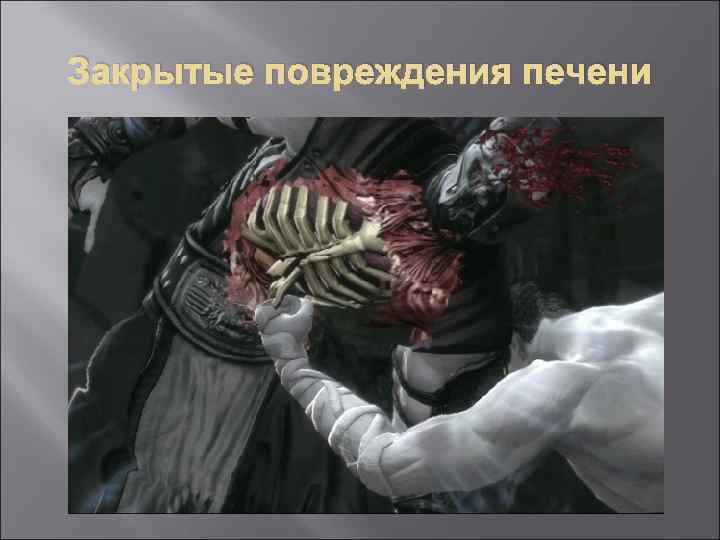 Закрытые повреждения печени 