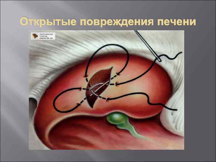 Открытые повреждения печени 